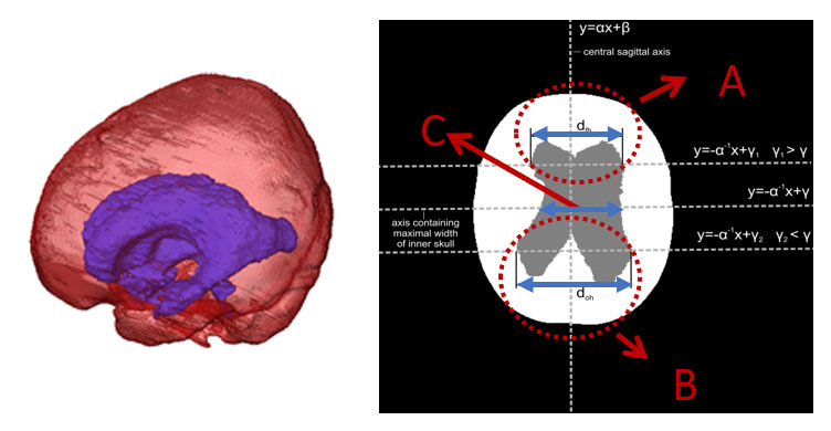 obraz rekonstrucji 3D mózgu i oceny zmian neurologicznych